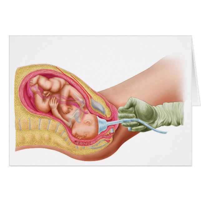 Levering foetus met vacuümextractie (Voorkant Horizontaal)