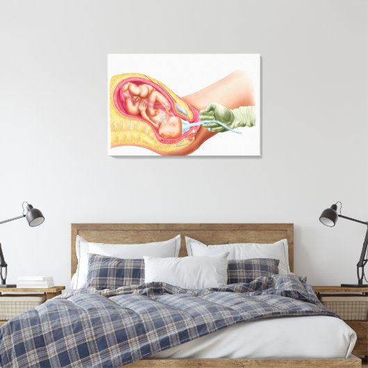 Levering foetus met vacuümextractie canvas afdruk (Insitu (Slaapkamer))
