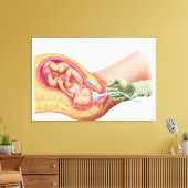 Levering foetus met vacuümextractie canvas afdruk (Insitu (Woonkamer))