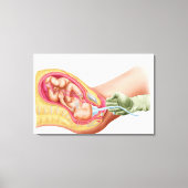 Levering foetus met vacuümextractie canvas afdruk (Voorkant)