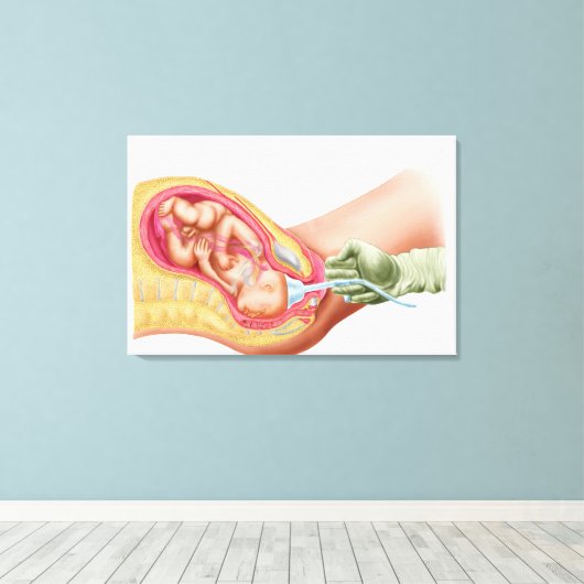 Levering foetus met vacuümextractie canvas afdruk (Insitu (Houten vloer))