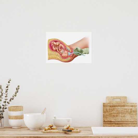 Levering foetus met vacuümextractie poster (Keuken)
