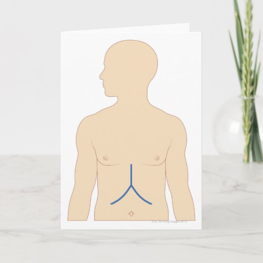 Levertransplantatie Kaart (Voorkant)