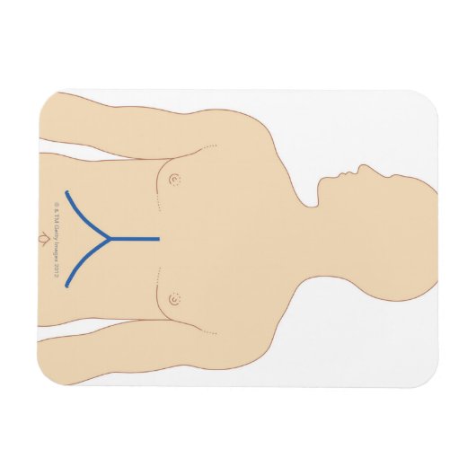 Levertransplantatie Magneet (Horizontaal)