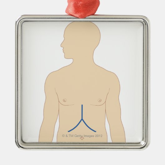 Levertransplantatie Metalen Ornament (Voorkant)