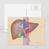 Levertransplantatieprocedure Briefkaart (Voorkant / Achterkant)