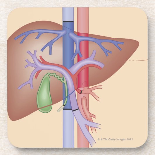 Levertransplantatieprocedure Onderzetter (Voorkant)