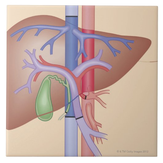 Levertransplantatieprocedure Tegeltje (Voorkant)