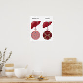 Liver disease Cirrhosis Poster (Keuken)