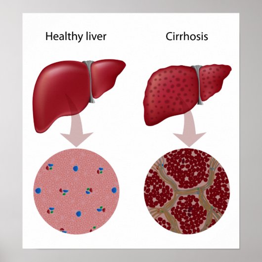 Liver disease Cirrhosis Poster (Voorkant)