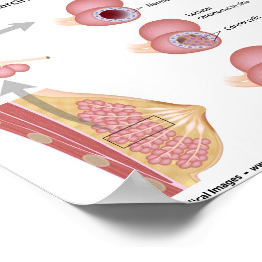 Lobulaire borstkanker, met een schema. poster (Hoek)