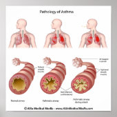 Longziekte Astma Poster (Voorkant)