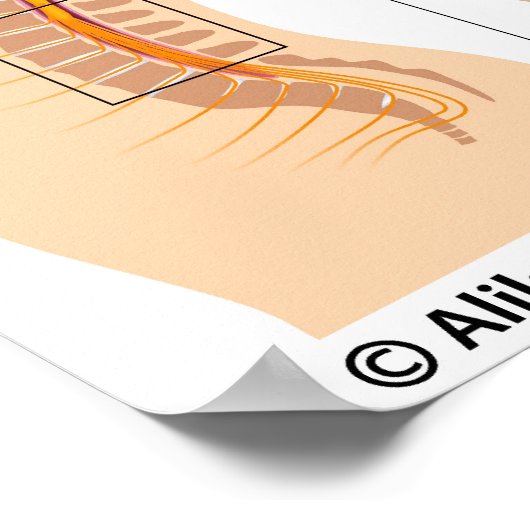 Lumbar epidurale injectie, met een schema. poster (Hoek)