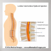 Lumbar epidurale injectie, met een schema. poster (Voorkant)