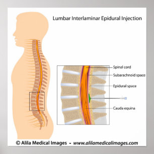 Lumbar epidurale injectie, met een schema. poster