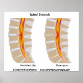 Lumbar Spinale Stenosis, medische tekening. Poster (Voorkant)
