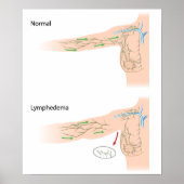 lymfoedeem arm poster (Voorkant)