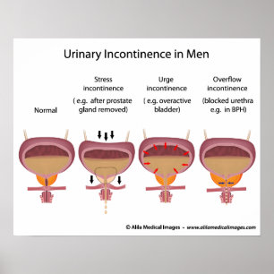 Mannelijke urine-incontinentie poster
