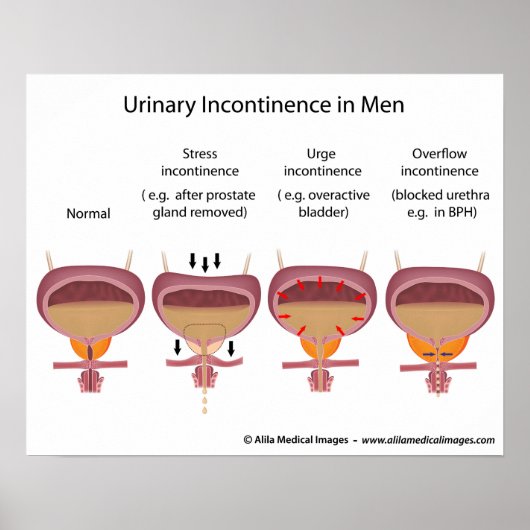 Mannelijke urine-incontinentie poster (Voorkant)