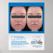 Marini Peel Clarify Resultaten 18x24" Poster (Voorkant)