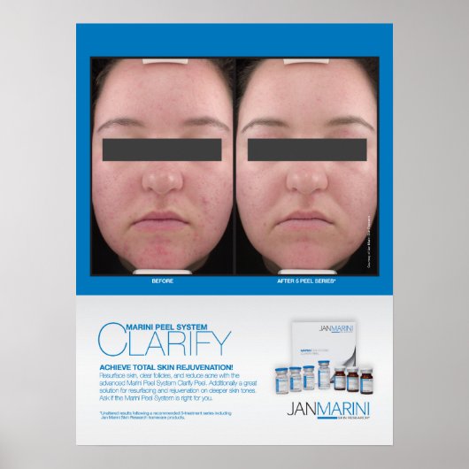 Marini Peel Clarify Resultaten 18x24" Poster (Voorkant)