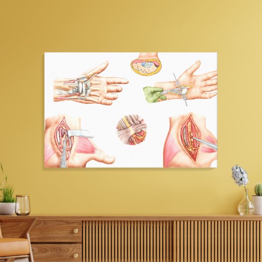 Medische illustratie met carpalettunnel canvas afdruk (Insitu (Woonkamer))