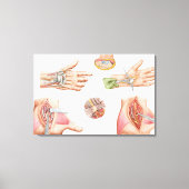 Medische illustratie met carpalettunnel canvas afdruk (Voorkant)