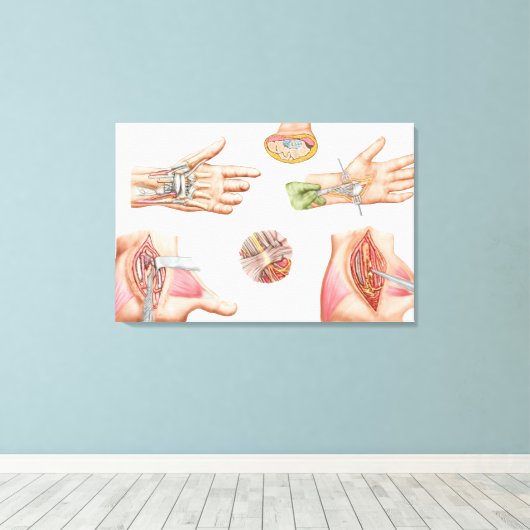 Medische illustratie met carpalettunnel canvas afdruk (Insitu (Houten vloer))