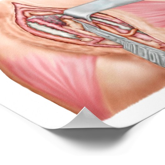 Medische illustratie met carpalettunnel poster (Hoek)