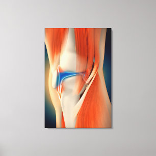 Medische illustratie: Ontsteking bij knie Canvas Afdruk