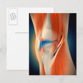 Medische Illustratie: Ontsteking in Knie Briefkaart (Voorkant / Achterkant)