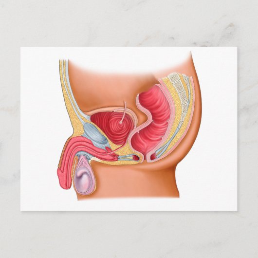 Medische illustratie van een recontrethrale fistel briefkaart (Voorkant)