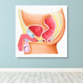 Medische illustratie van een recontrethrale fistel canvas afdruk (Insitu (Houten vloer))