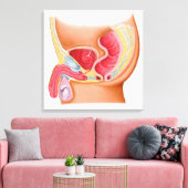 Medische illustratie van een recontrethrale fistel canvas afdruk (Insitu (Woonkamer))