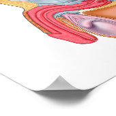 Medische illustratie van een recontrethrale fistel poster (Hoek)