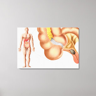 Medische isolatie van een aanhangsel canvas afdruk