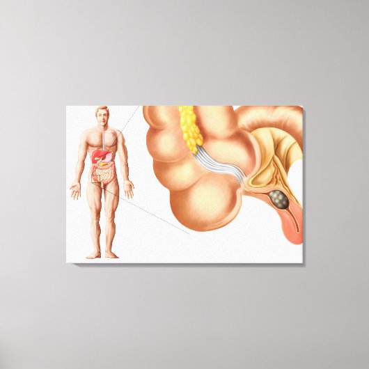 Medische isolatie van een aanhangsel canvas afdruk (Voorkant)