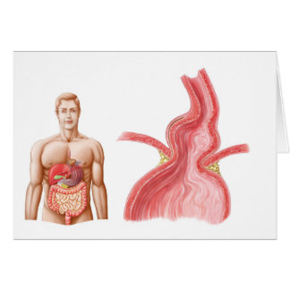 Medische isolatie van een Hiatale Hernia in de