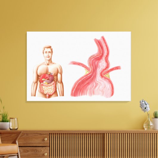 Medische isolatie van een Hiatale Hernia in de Canvas Afdruk (Insitu (Woonkamer))