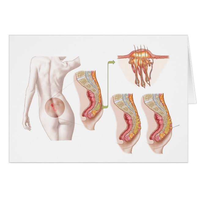 Medische isolatie van een proefcyclus (Voorkant Horizontaal)
