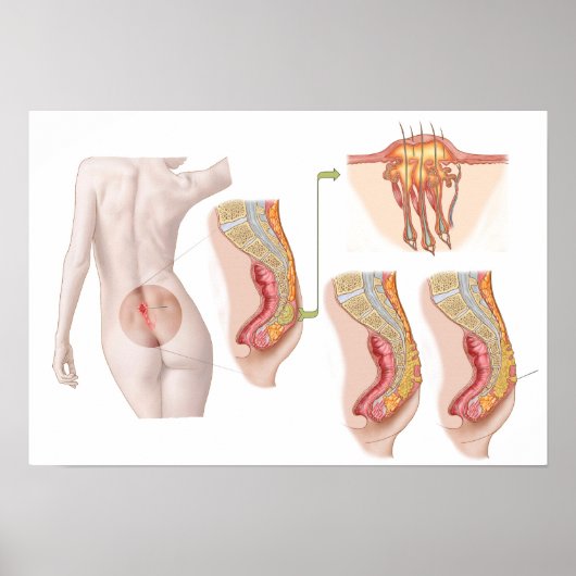 Medische isolatie van een proefcyclus poster (Voorkant)