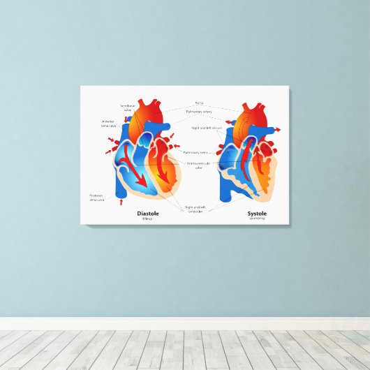 Medische kaart met hartbloeding canvas afdruk (Insitu (Houten vloer))
