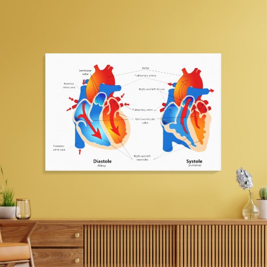 Medische kaart met hartbloeding canvas afdruk (Insitu (Woonkamer))
