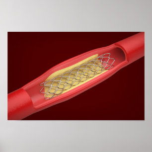 Medische stent in bloedvat poster