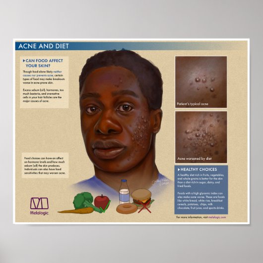 Melalogic Acne en Dieet Medisch Poster (Voorkant)