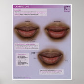 Melalogic Chapped Lips Medical Poster (Voorkant)