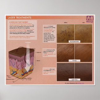 Melalogic Laser Treatment Medical Poster