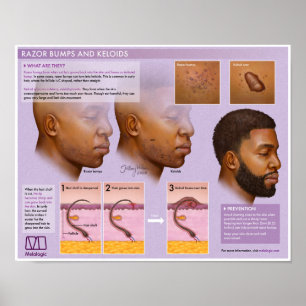 Melalogic Razor Bumps and Keloids Medical Poster