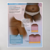 Melalogic Stretch Marks Medical Poster (Voorkant)
