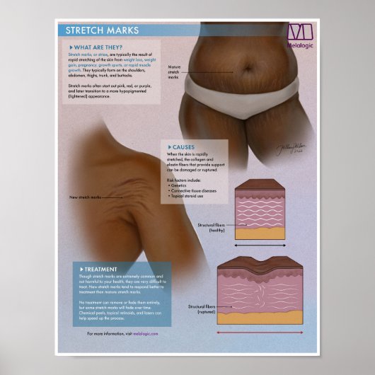 Melalogic Stretch Marks Medical Poster (Voorkant)